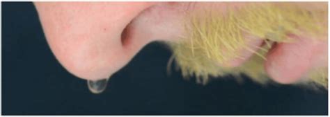 thin yellow fluid leaking from nose|CSF Leaks of the Nose: The Answers to All Your FAQs